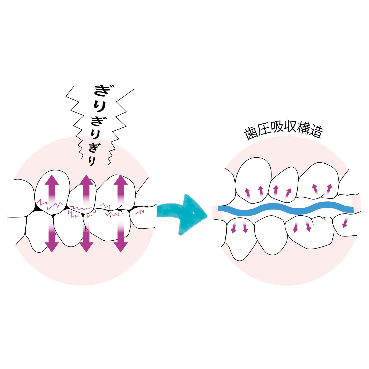 フラフィール|波形状シリコーンが 歯圧を吸収！ 歯ぎしり対策マウスピース|歯ぎしりや食いしばりから大切な歯を守ります！